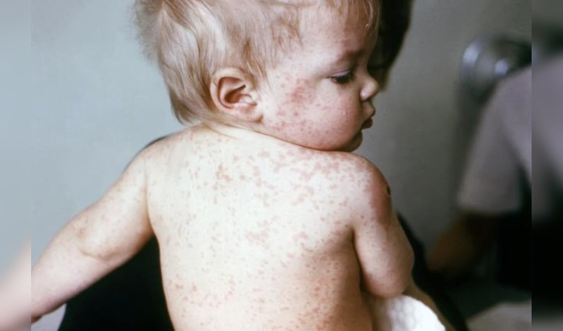 Kinderen onder de 14 maanden kunnen niet gevaccineerd worden en lopen een hoger risico. 