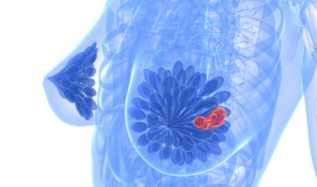 <p>Een vrouwenborst met tumor.</p>