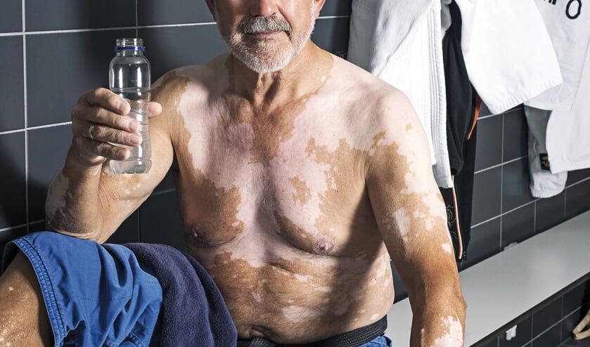 Leo Pekaar uit Yerseke is model voor belangenorganisatie Vitiligo.