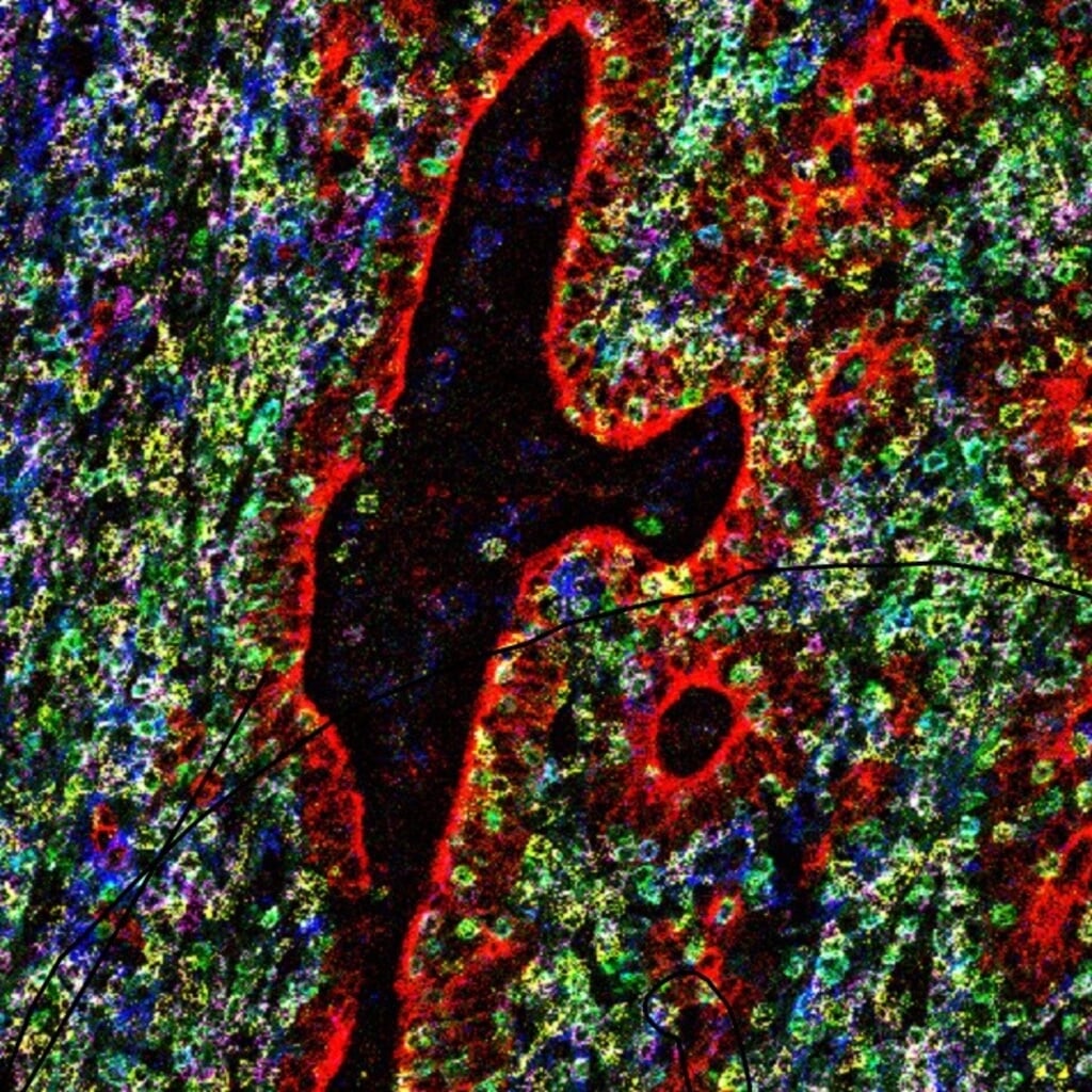 Darmkankercellen (in rood) omgeven door talloze immuuncellen na immuuntherapie.