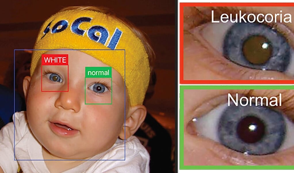 Een abnormale witte reflectie van een pupil na een foto kan duiden op de aanwezigheid van retinoblastoom 