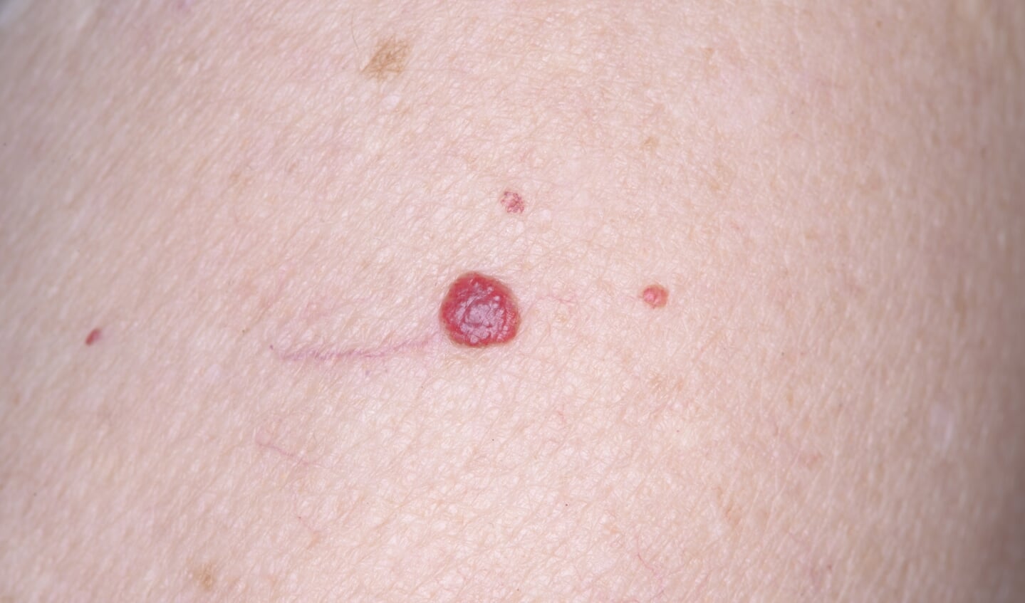 Een angioma senilis is vaak kersenrood van kleur. De grootte kan variëren tot enkele millimeters.