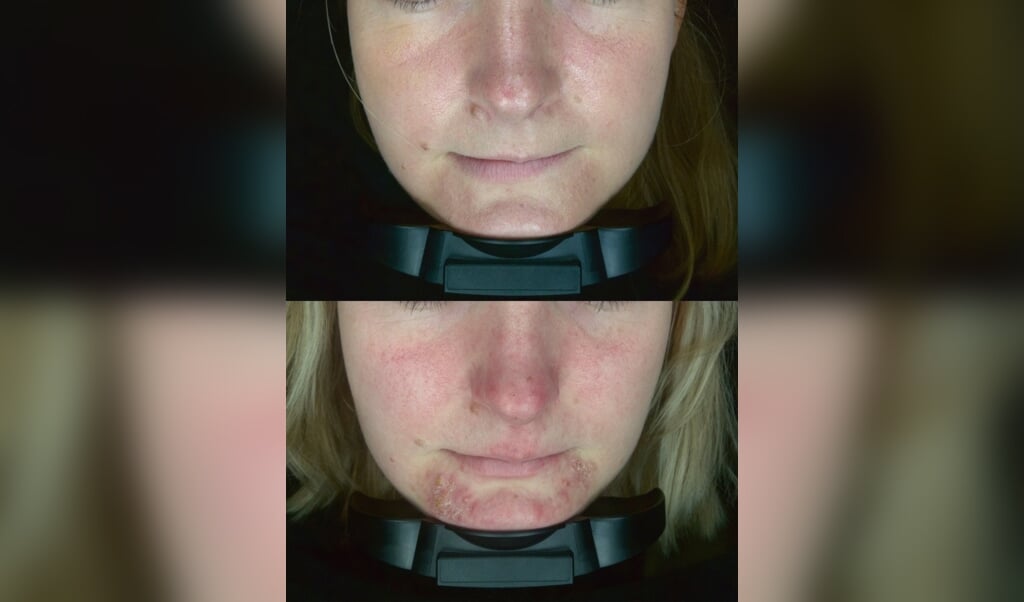 Huidirritatie door een mondkapje. Onder een foto van voor de behandeling en boven van erna.