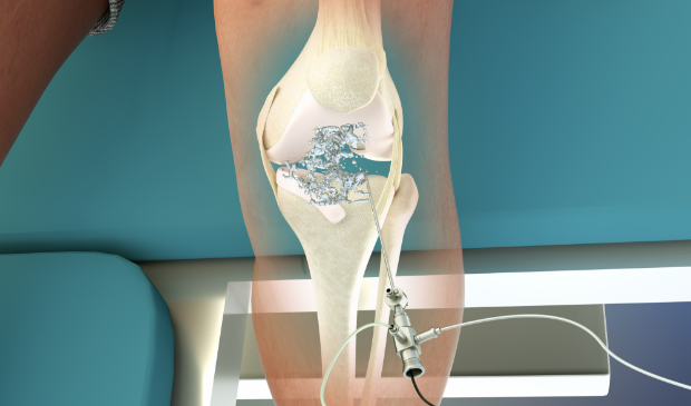 Animatie van een behandeling aan de knie