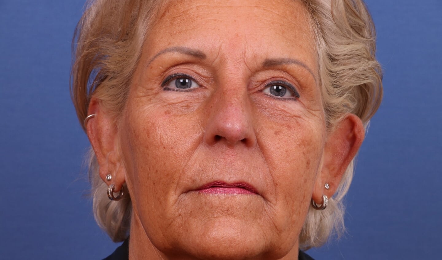 Anita Mulder, na de ingreep.