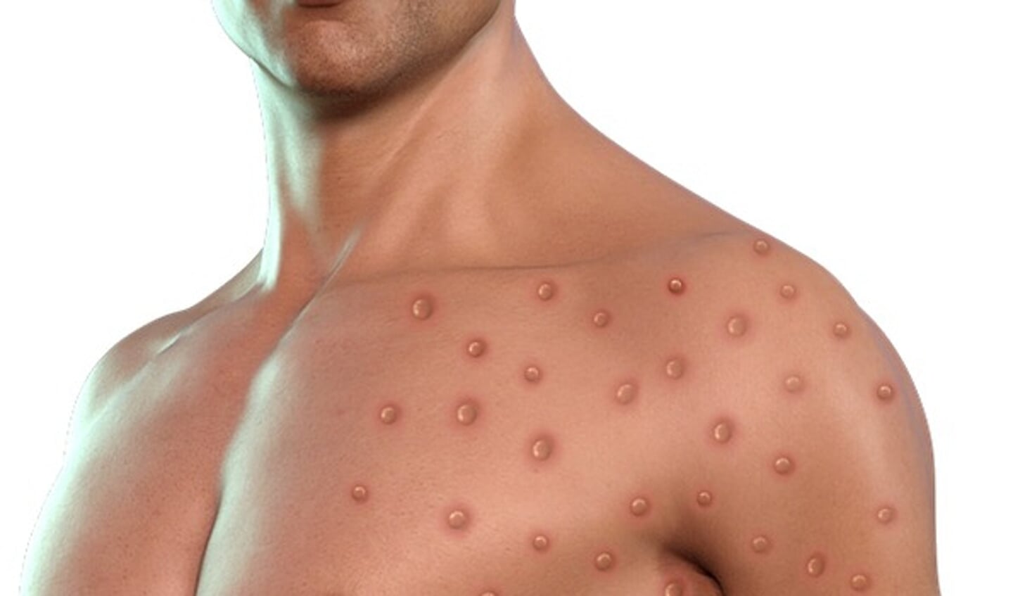Dit is een digitaal bewerkte foto waarop een impressie van blaasjes op de huid als gevolg van besmetting met het apenpokkenvirus wordt gegeven