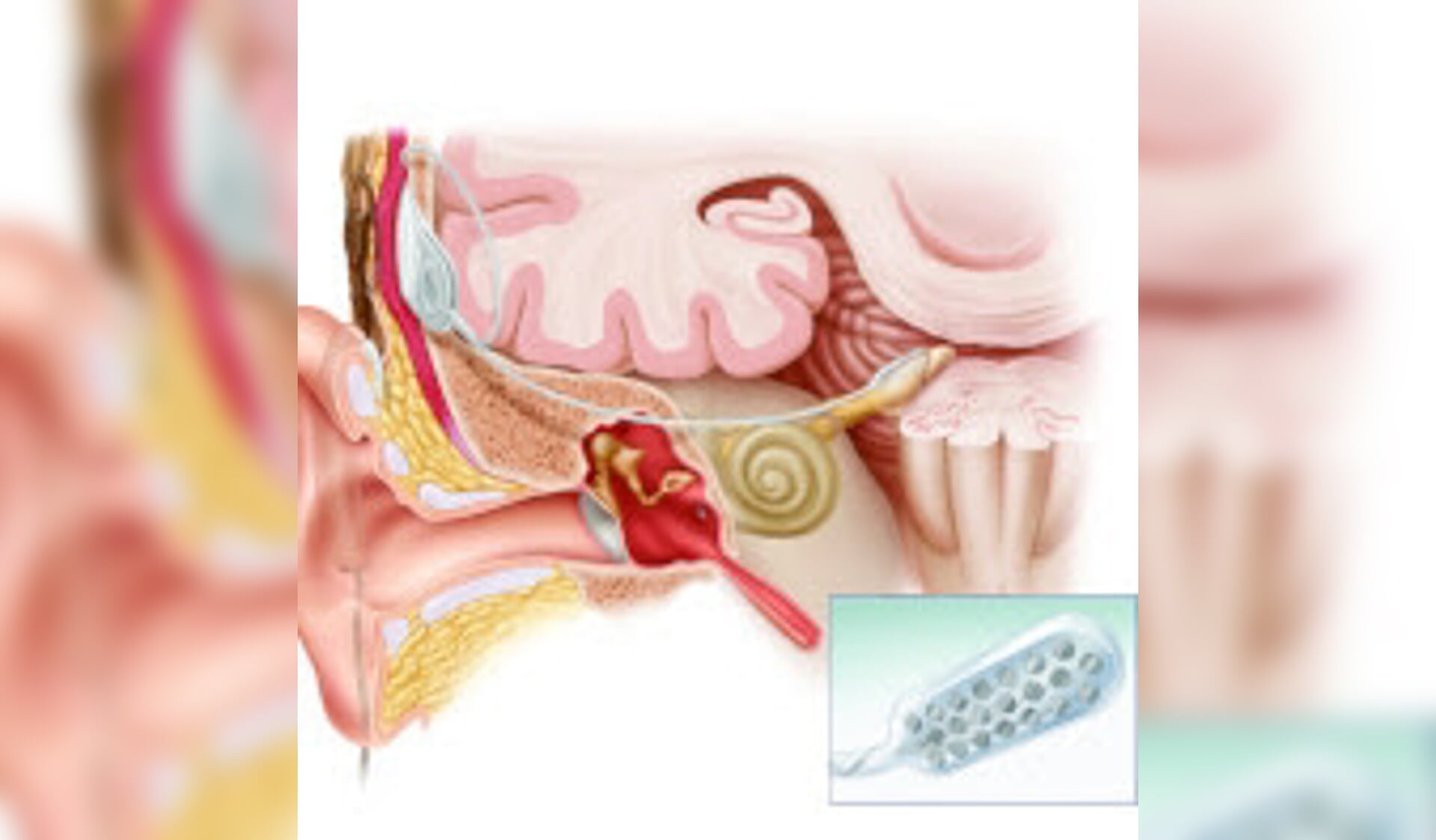 Een implantaat voor gehoorverbetering lijkt inzetbaar tegen tinnitus.
