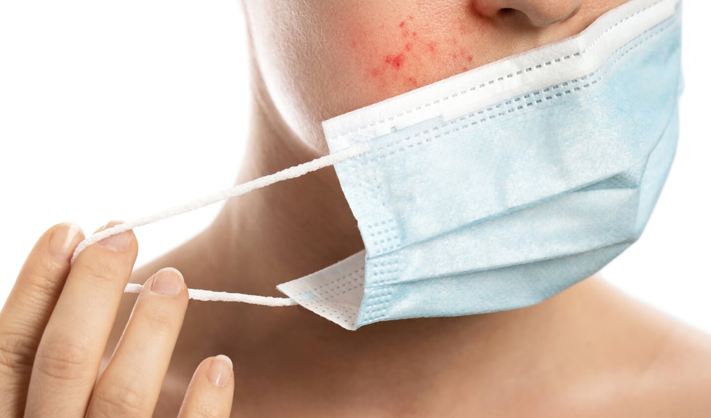 Als gevolg van het mondkapjesgebruik ziet dermatoloog Menno Gaastra meer mensen met huidproblemen.