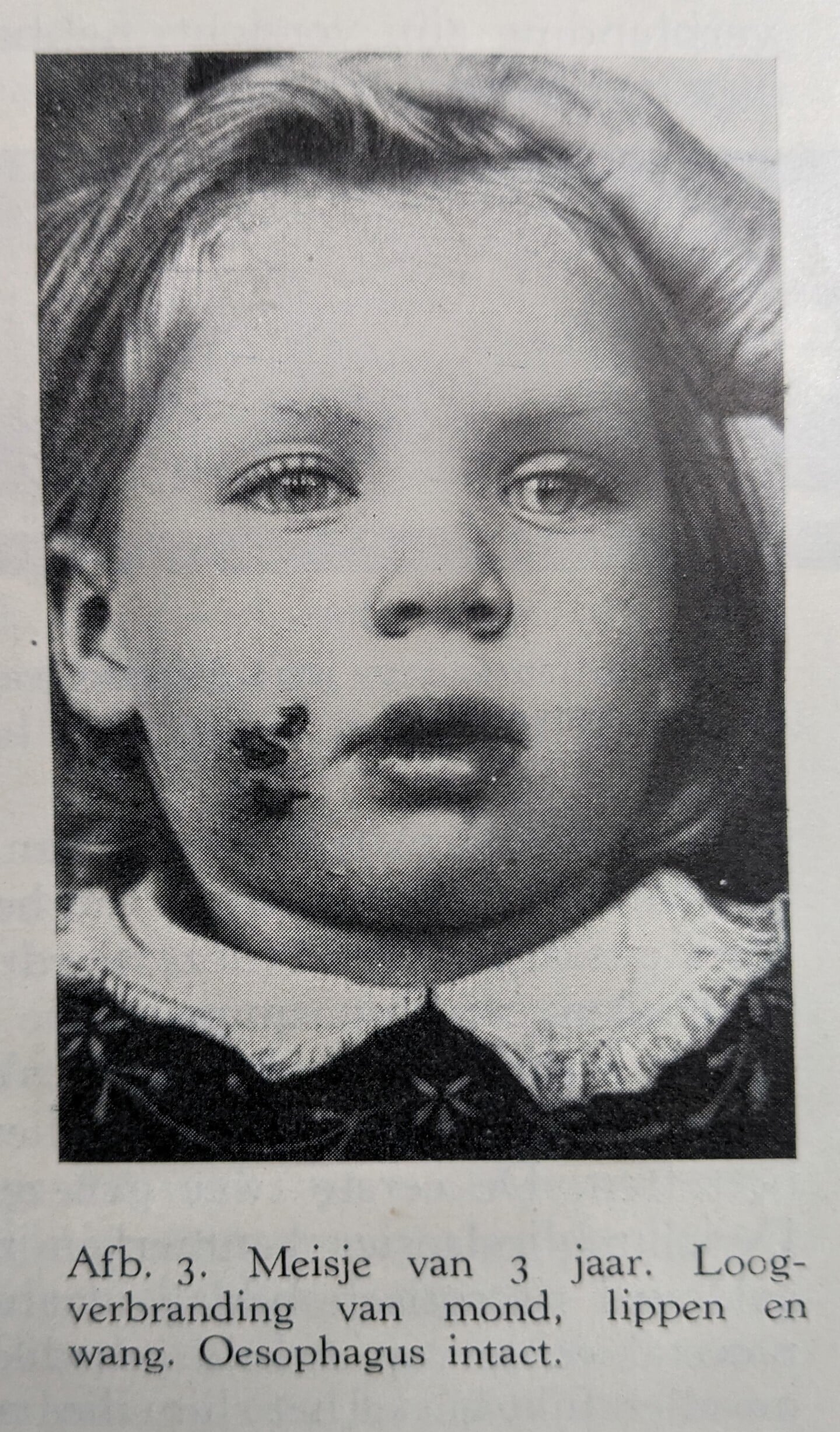 Een meisje met loogverbranding uit het onderzoek van de artsen Huizinga en Westerbeek.