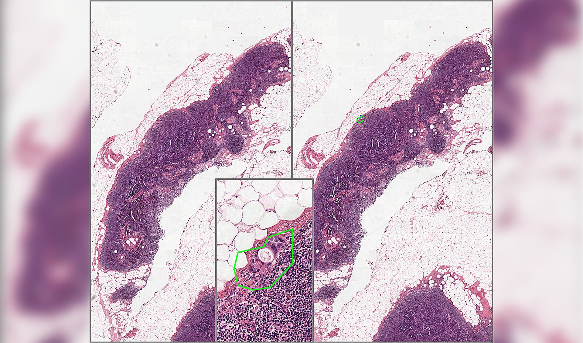 Peter Bult: ‘Hier ziet de computer onterecht bloedvaatjes en stukjes van het kapsel van de lymfeklier aan voor tumorweefsel. Dit komt omdat we het systeem nog onvoldoende hebben getraind op deze situaties. Voor een patholoog is dit zeer eenvoudig te onderscheiden van tumorcellen.’