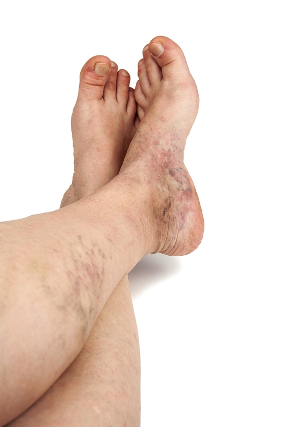 Gezond: Krijg je spataderen van zitten met gekruiste benen? (istock)