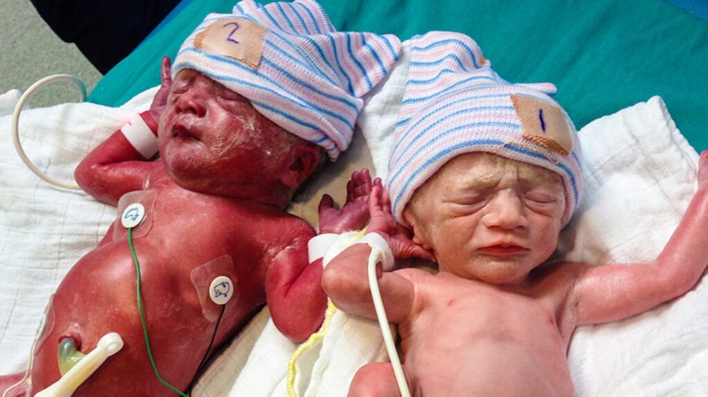 De foto van de rood-witte Almeerse tweeling wordt veel gebruikt om de tekenen van TAPS bij de geboort te laten zien. (Eigen foto)