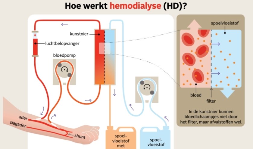 Voor iemand een donornier krijgt, is er vaak al een lange periode van dialyse aan voorafgegaan, meerdere keren per week, urenlang.