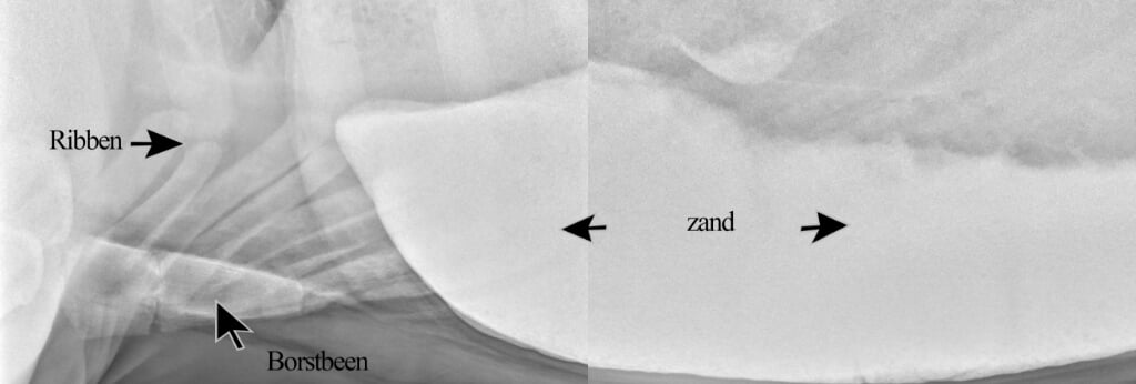 Op deze röntgenfoto is de dikke darm gevuld met een grote hoeveelheid zand.