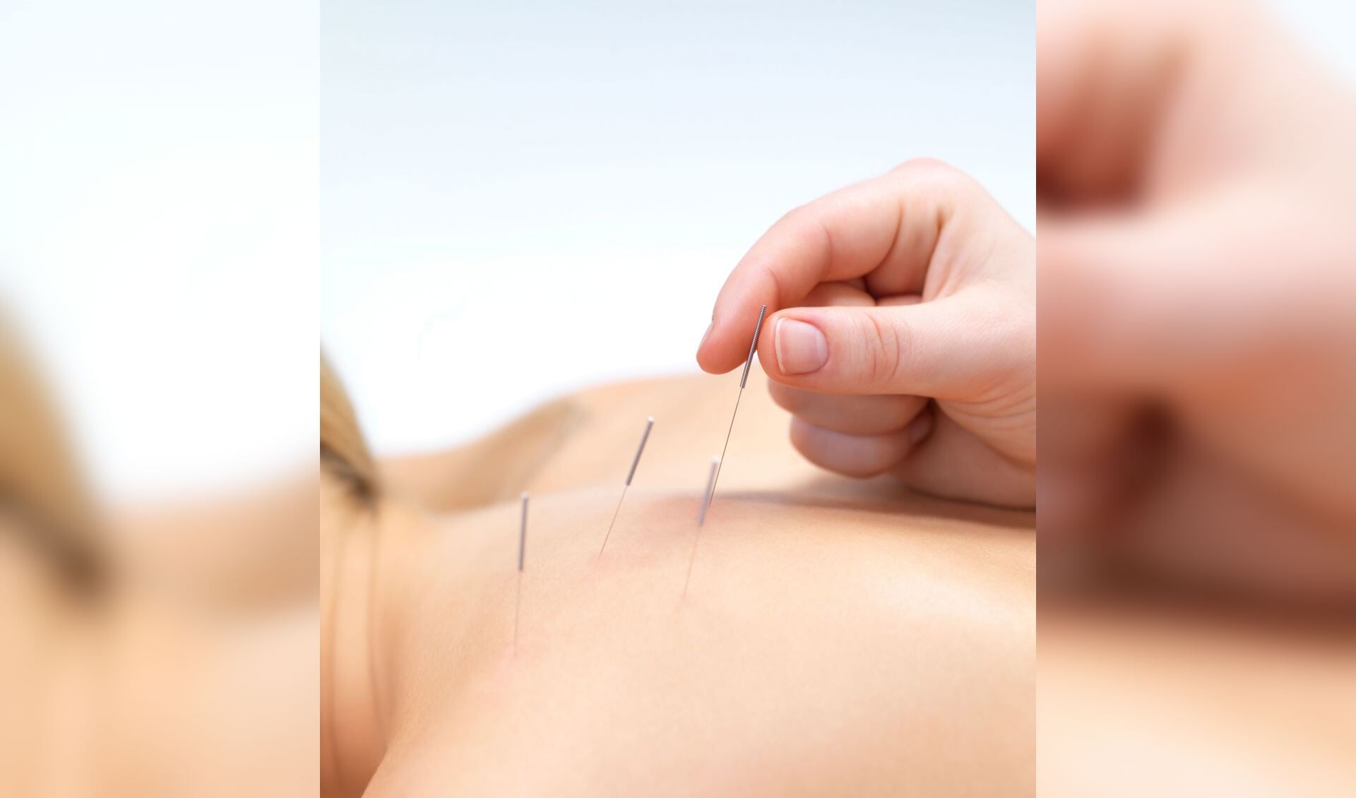 Acupunctuur wordt ingezet om klachten te verlichten en ziekten te genezen.
