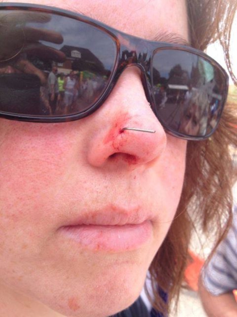 Een vishaakje belandde in de neus van een toeriste. 