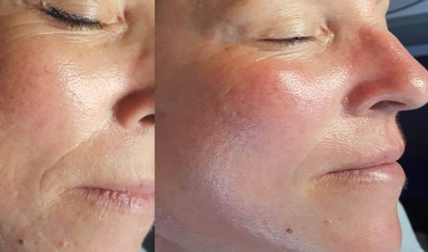 De grondige anti-aging behandelingen van Mijn Huidspecialist verjongen en verstevigen de huid zichtbaar.
